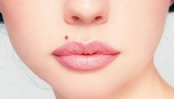 人為什么會長痣,痣越來越多怎么辦