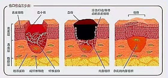 為什么傷口愈合時會感覺癢,傷口愈合特別癢怎么辦