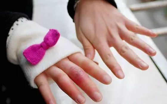 人為什么會(huì)生凍瘡,生凍瘡怎么辦