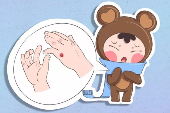 人為什么會(huì)生凍瘡,生凍瘡怎么辦