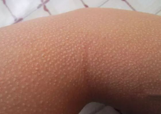 人為什么會(huì)起雞皮疙瘩