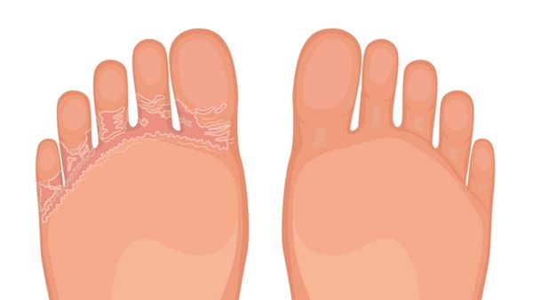 為什么叫香港腳,香港腳是什么意思