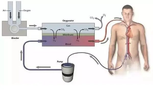 ECMO是什么意思,ecmo英語(yǔ)怎么讀,ecmo為什么這么貴